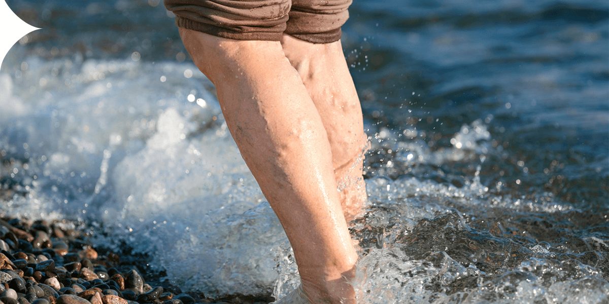 Tengo varices: ¿Qué puedo hacer al respecto? Explorando la salud vascular y las soluciones cosméticas